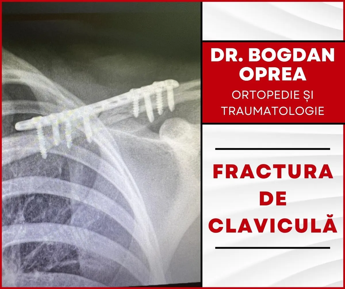 Sfatul Medicului-FRACTURA DE CLAVICULĂ